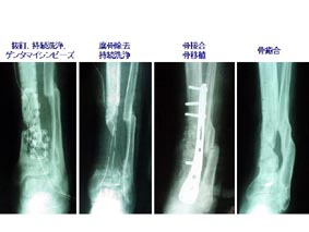 脛骨感染性偽関節(38歳男性) 写真